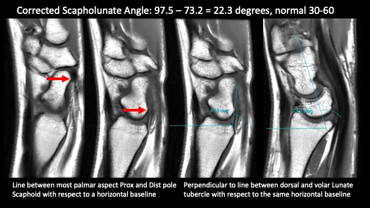 Ulnar Wrist Pain, MRI. 32F 1.5 Yrs Post Op TFCC Debridement With ...